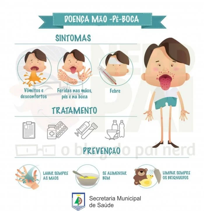 Saúde alerta para síndrome mão-pé-boca em crianças